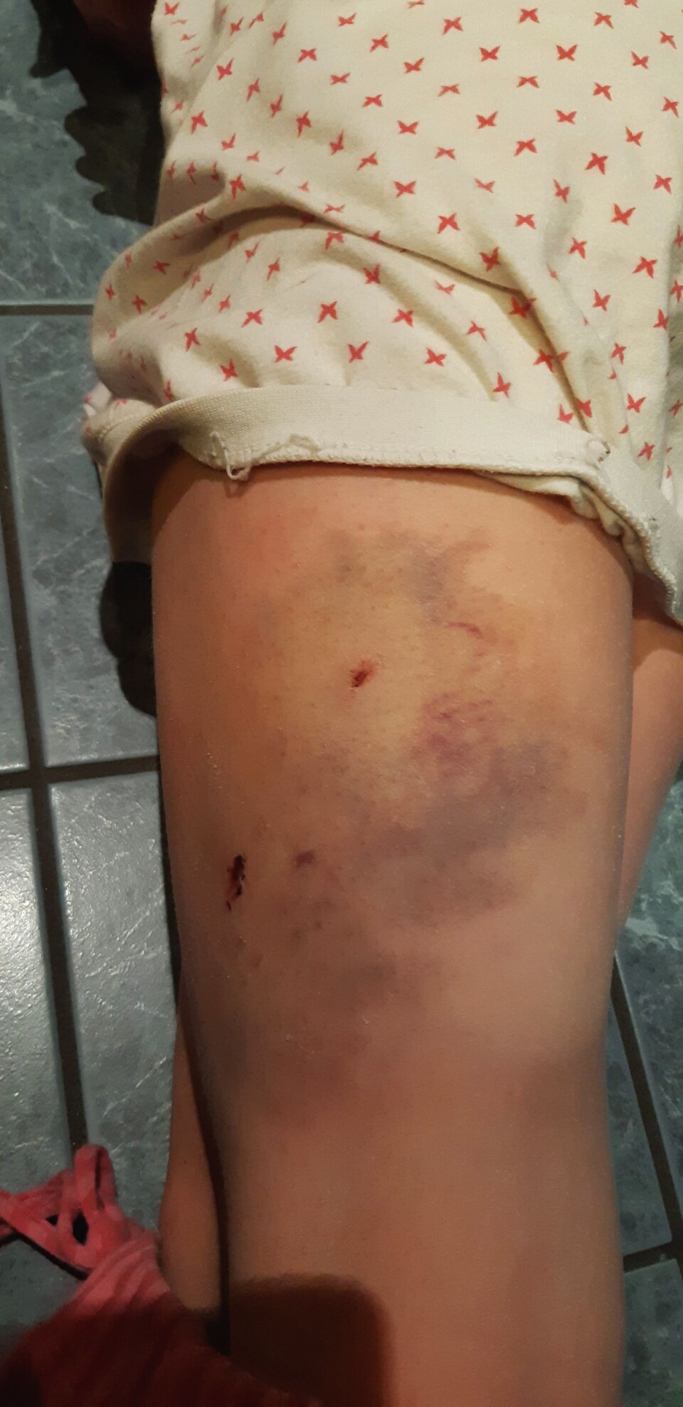 BITT: Jenta ble bitt på vei hjem fra skolen.