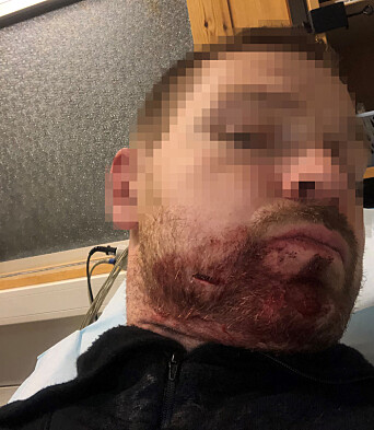 SKUTT OG KNIVSTUKKET:– Uten at jeg så det hadde han plutselig en slaktekniv som stakk ut fra knyttneven som han slo meg med i ansiktet uten forvarsel, forteller polititjenestemannen. SKUTT OG KNIVSTUKKET:– Uten at jeg så det hadde han plutselig en slaktekniv som stakk ut fra knyttneven som han slo meg med i ansiktet uten forvarsel, forteller polititjenestemannen.