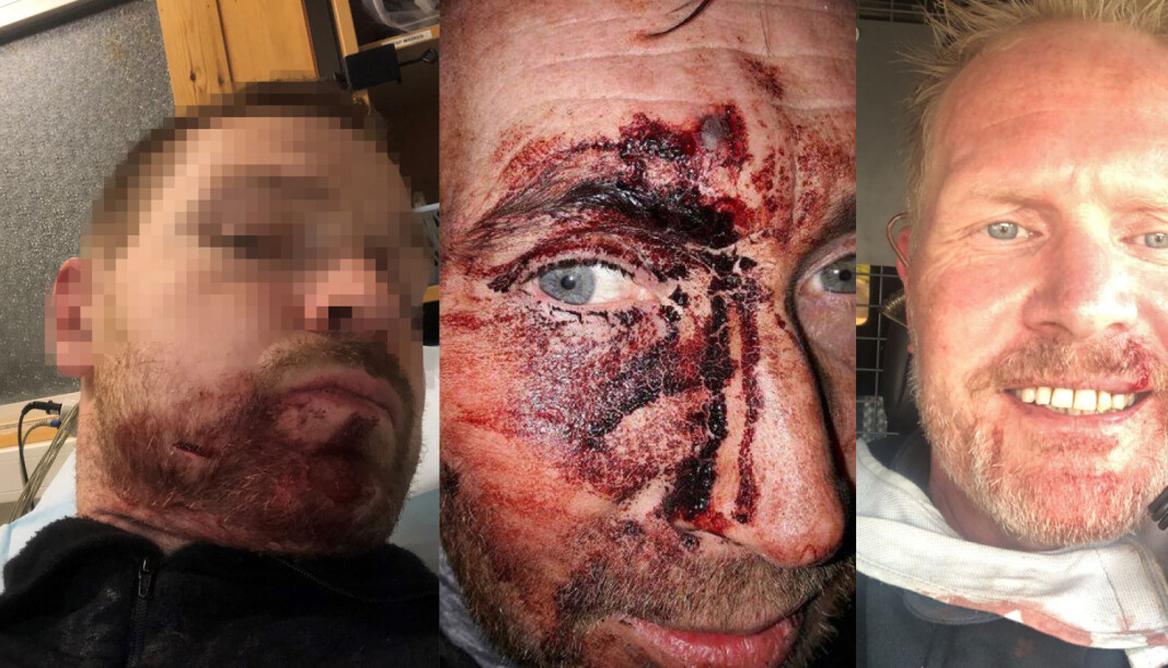 BRUTALE OVERFALL i TJENESTE: Polititjenestemannen (til venstre) ble knivstukket i ansiktet, da han forsøkte å overtale en psykisk syk person til å bli med ham til legevakten. Mens hundefører Morten Ingolf Johansen takker politihunden Tim for at han lever, og tilfeldigheter gjorde at Emil Ødegård ikke fikk slått ut tennene sine. BRUTALE OVERFALL i TJENESTE: Polititjenestemannen (til venstre) ble knivstukket i ansiktet, da han forsøkte å overtale en psykisk syk person til å bli med ham til legevakten. Mens hundefører Morten Ingolf Johansen takker politihunden Tim for at han lever, og tilfeldigheter gjorde at Emil Ødegård ikke fikk slått ut tennene sine.