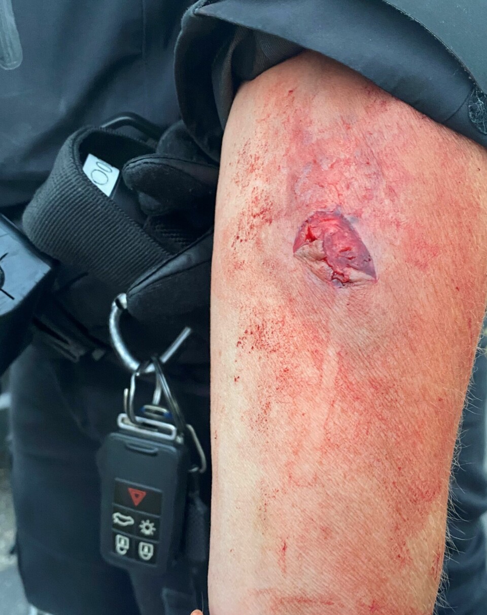 BLODIG: Slik så såret til politibetjenten ut etter bittet.
